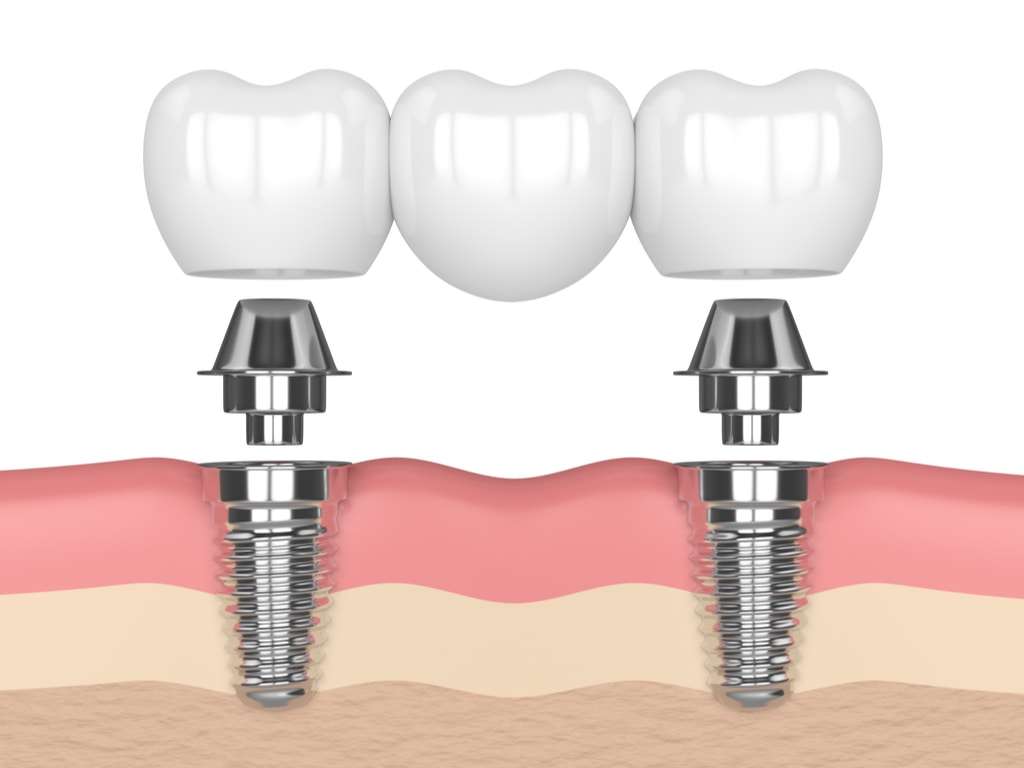 bridge dentaire sur implants